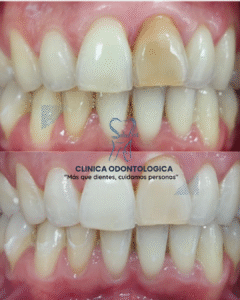 Post Instagram Fotos Momentos Collage Simple Blanco (1)